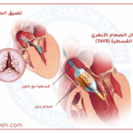 اكتشف كل ما تحتاج معرفته عن زراعة الصمام الأبهري عن طريق القسطرة مع الدكتور عبد الحكيم ديه، أحد أبرز أطباء جراحة القلب في المنطقة. إجراء آمن، دقيق، وبدون جراحة.