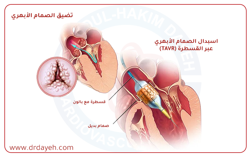 اكتشف كل ما تحتاج معرفته عن زراعة الصمام الأبهري عن طريق القسطرة مع الدكتور عبد الحكيم ديه، أحد أبرز أطباء جراحة القلب في المنطقة. إجراء آمن، دقيق، وبدون جراحة.