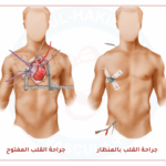 جراحة القلب بالمنظار