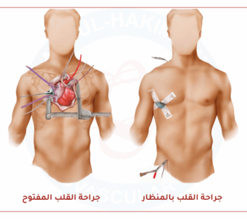 جراحة القلب بالمنظار